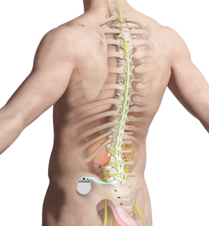 Spinal cord stimulation doesn't help with back pain, says new review